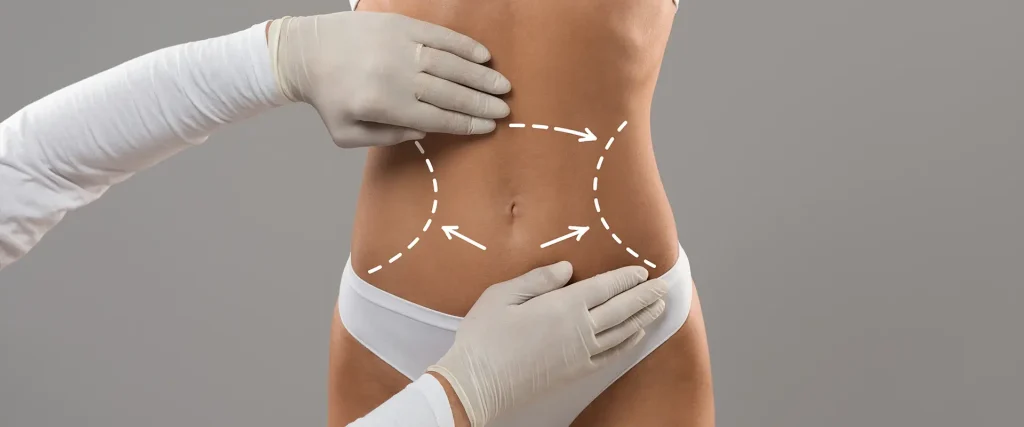 Liposuction Liposuction