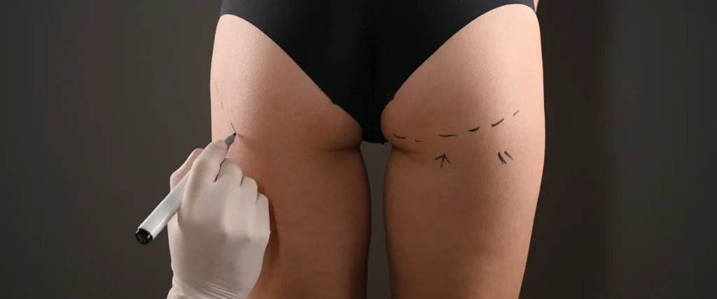 Thigh Lift Surgery Thigh Lift Surgery