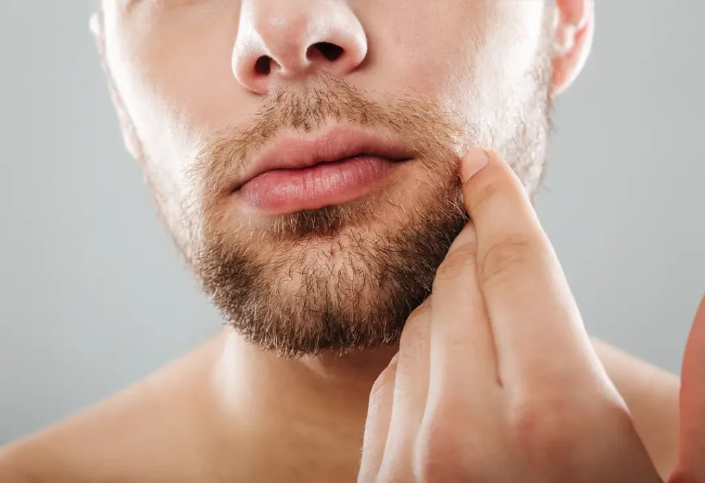 Beard & Mustache Transplant Beard & Mustache Transplant