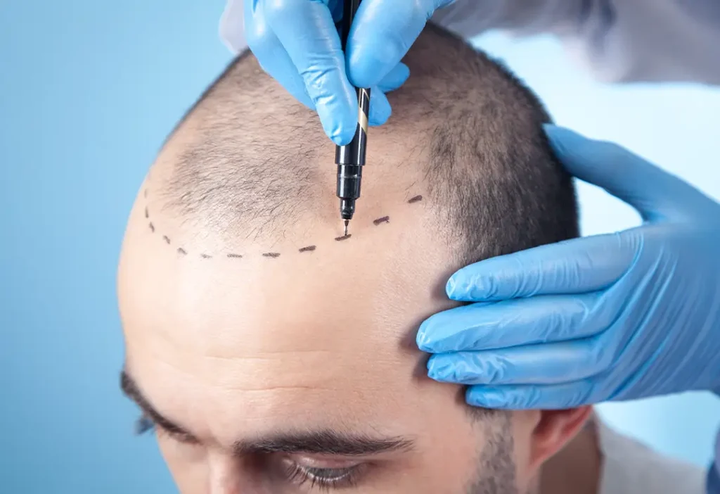 FUE Hair Transplant FUE Hair Transplantation