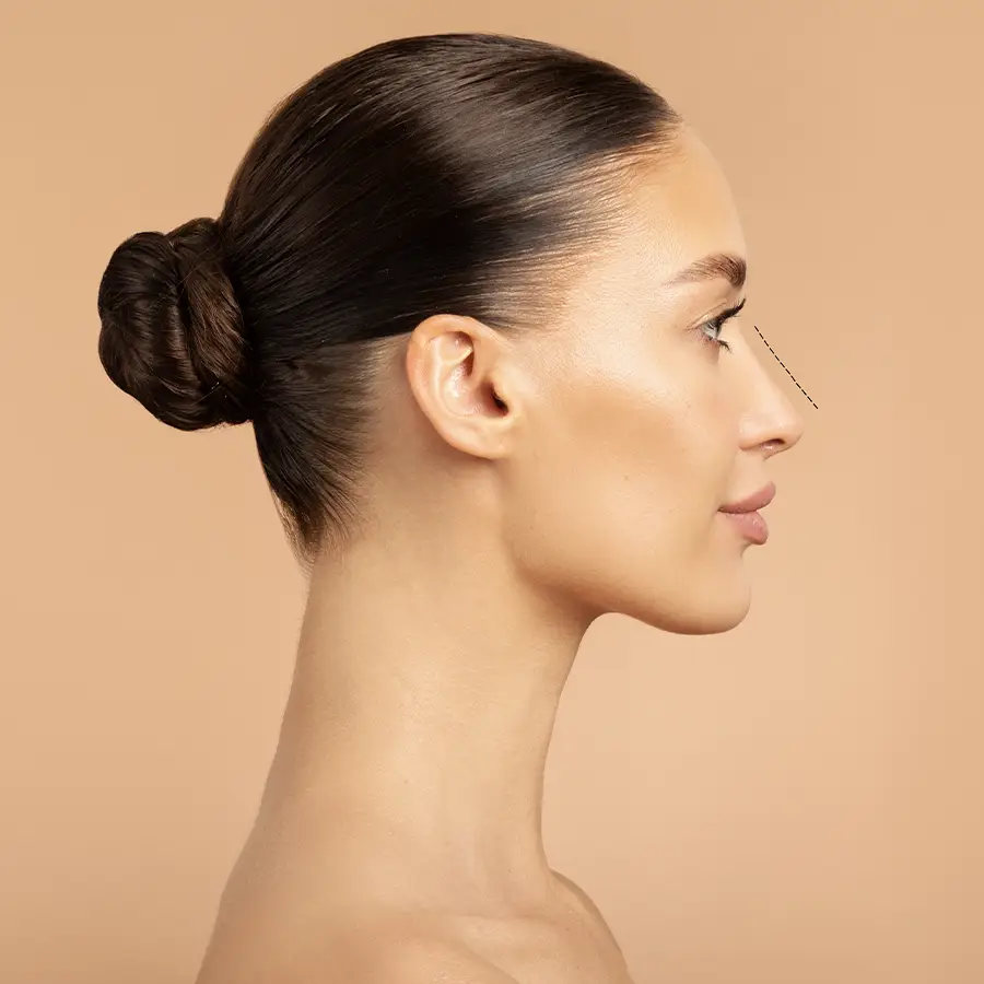 Rhinoplasty (Nose Surgery) Rhinoplasty