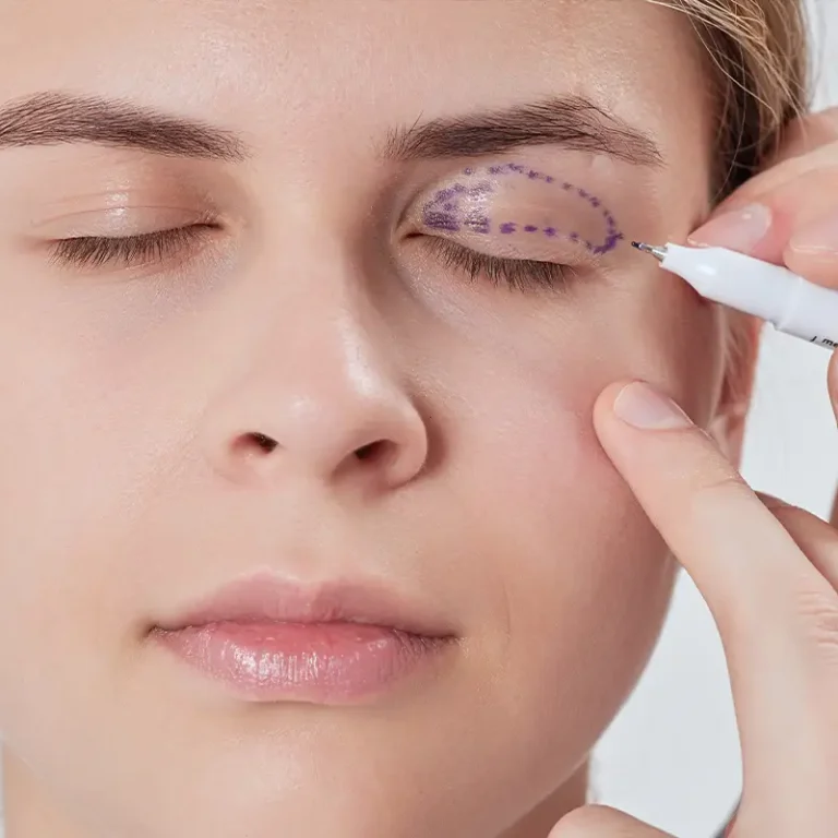 Eyelid Surgery