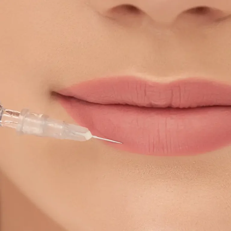 Lip Filler